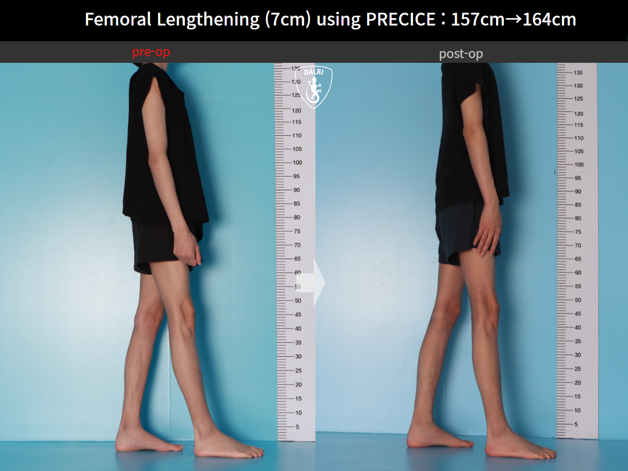 Before and after cll precice, case 31554406, image 5, Dr. Donghoon institute (DALRI)