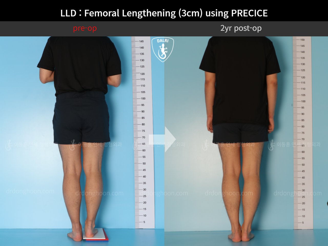 Before and after adult lld, case 10665047, image 2, Dr. Donghoon institute (DALRI)