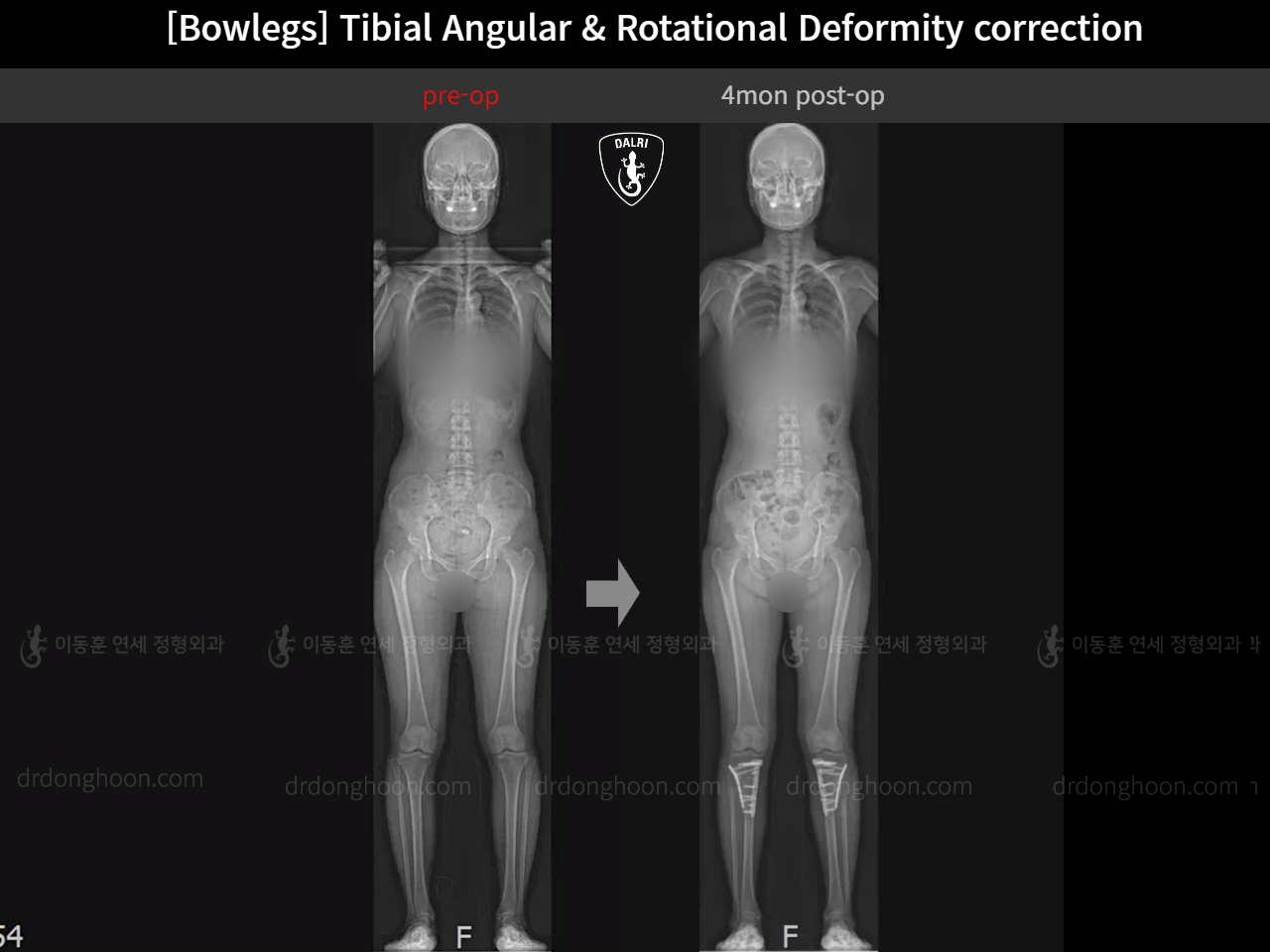 Before and after adult bowlegs, case 16530390, image 12, Dr. Donghoon institute (DALRI)