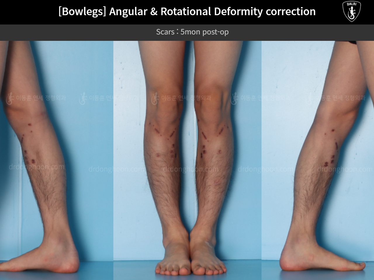 Before and after adult bowlegs, case 14707617, image 6, Dr. Donghoon institute (DALRI)