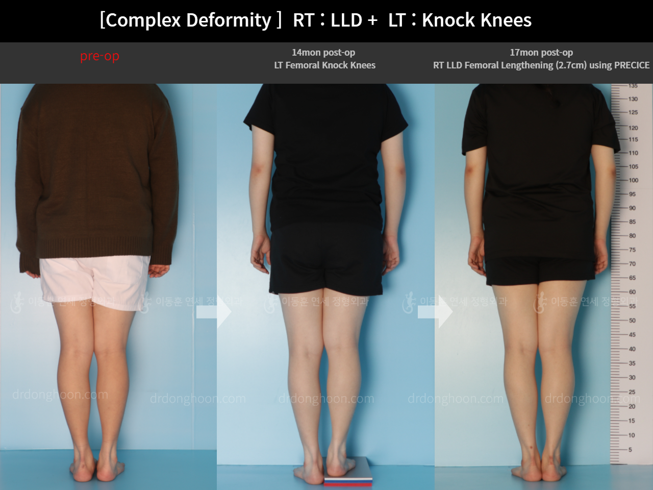 [Complex Deformity ] RT : LLD + LT : Knock Knees : Complex Deformity