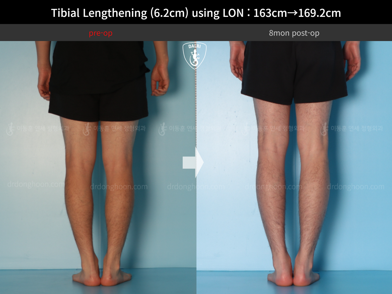 Before and after cll lon, case 14135787, image 8, Dr. Donghoon institute (DALRI)