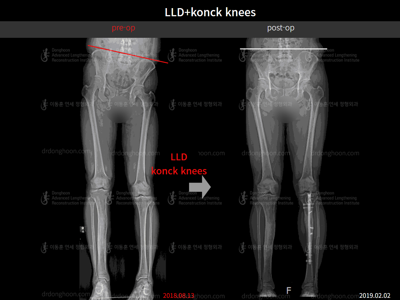 Before and after complex deformity, case 8815392, image 5, Dr. Donghoon institute (DALRI)