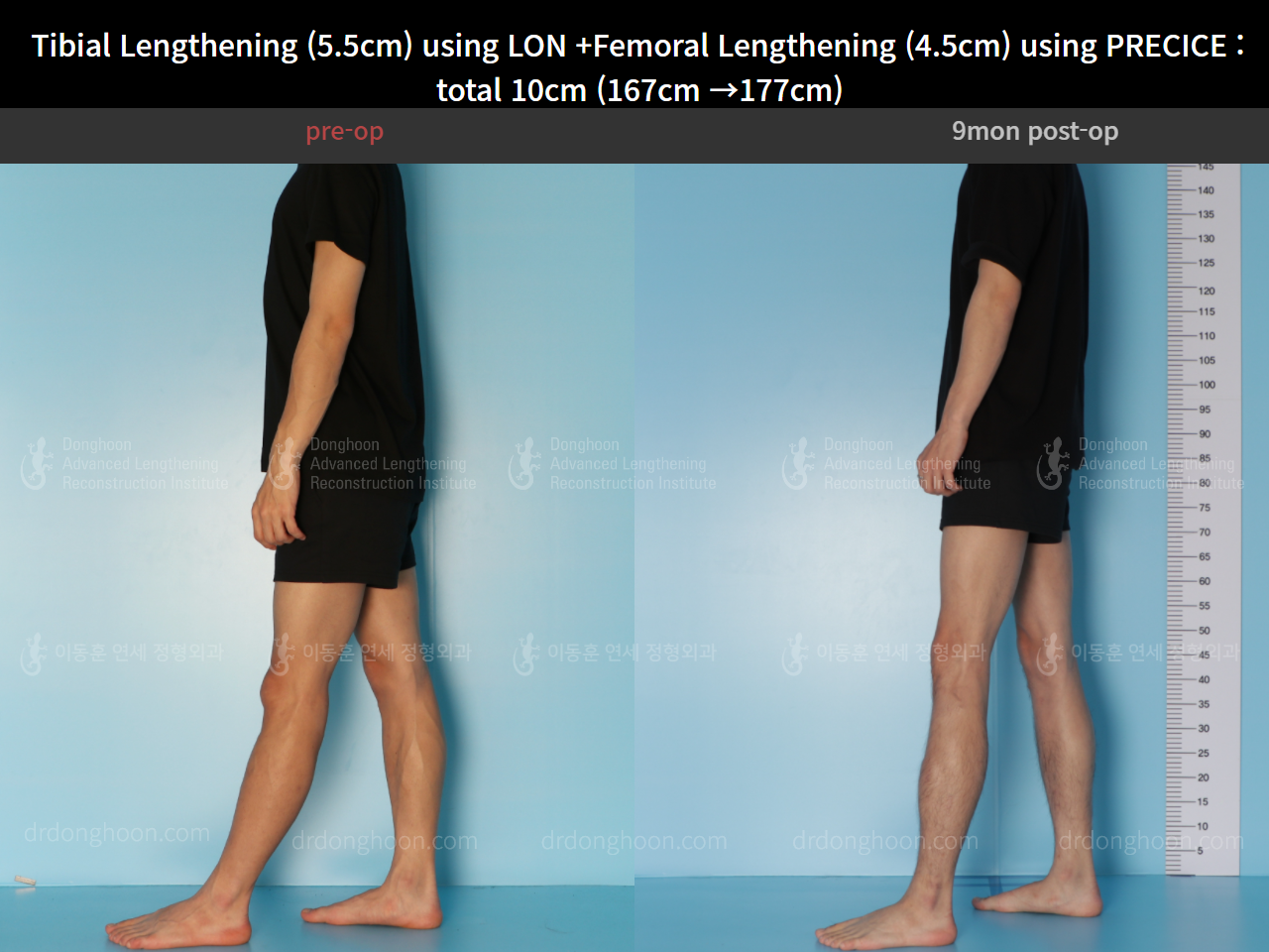 Before and after cll precice, case 4662233, image 3, Dr. Donghoon institute (DALRI)