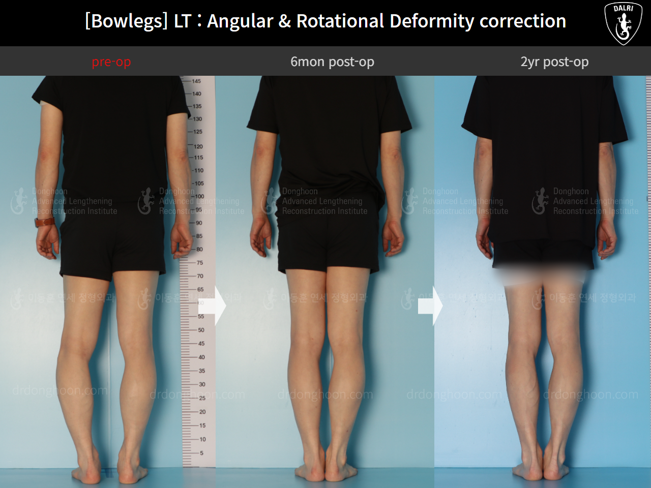 Before and after adult bowlegs, case 15111863, image 2, Dr. Donghoon institute (DALRI)