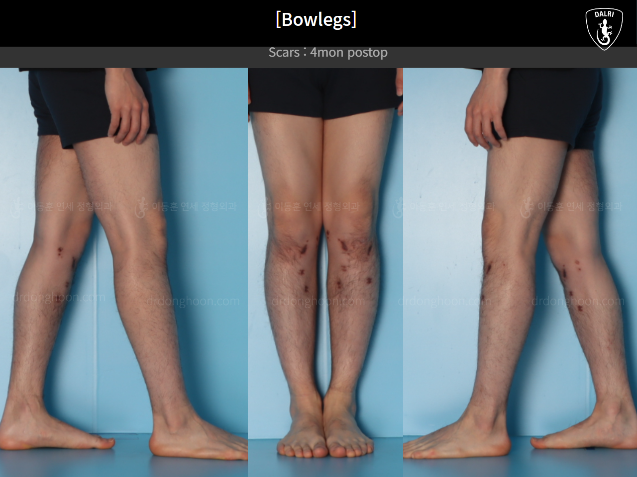 Before and after adult bowlegs, case 21098909, image 11, Dr. Donghoon institute (DALRI)