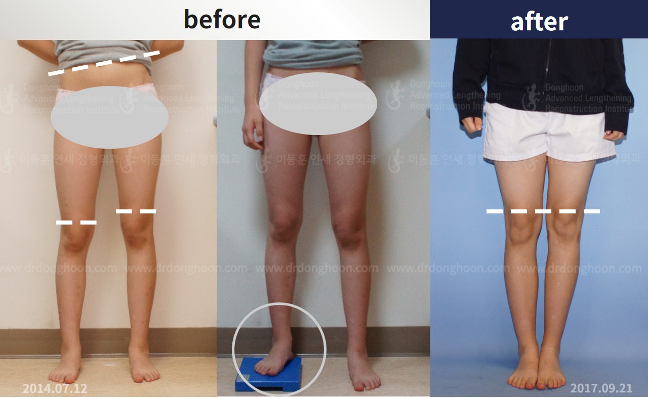 Before and after paediatric & adolescent lld, case 4320411, image 1, Dr. Donghoon institute (DALRI)