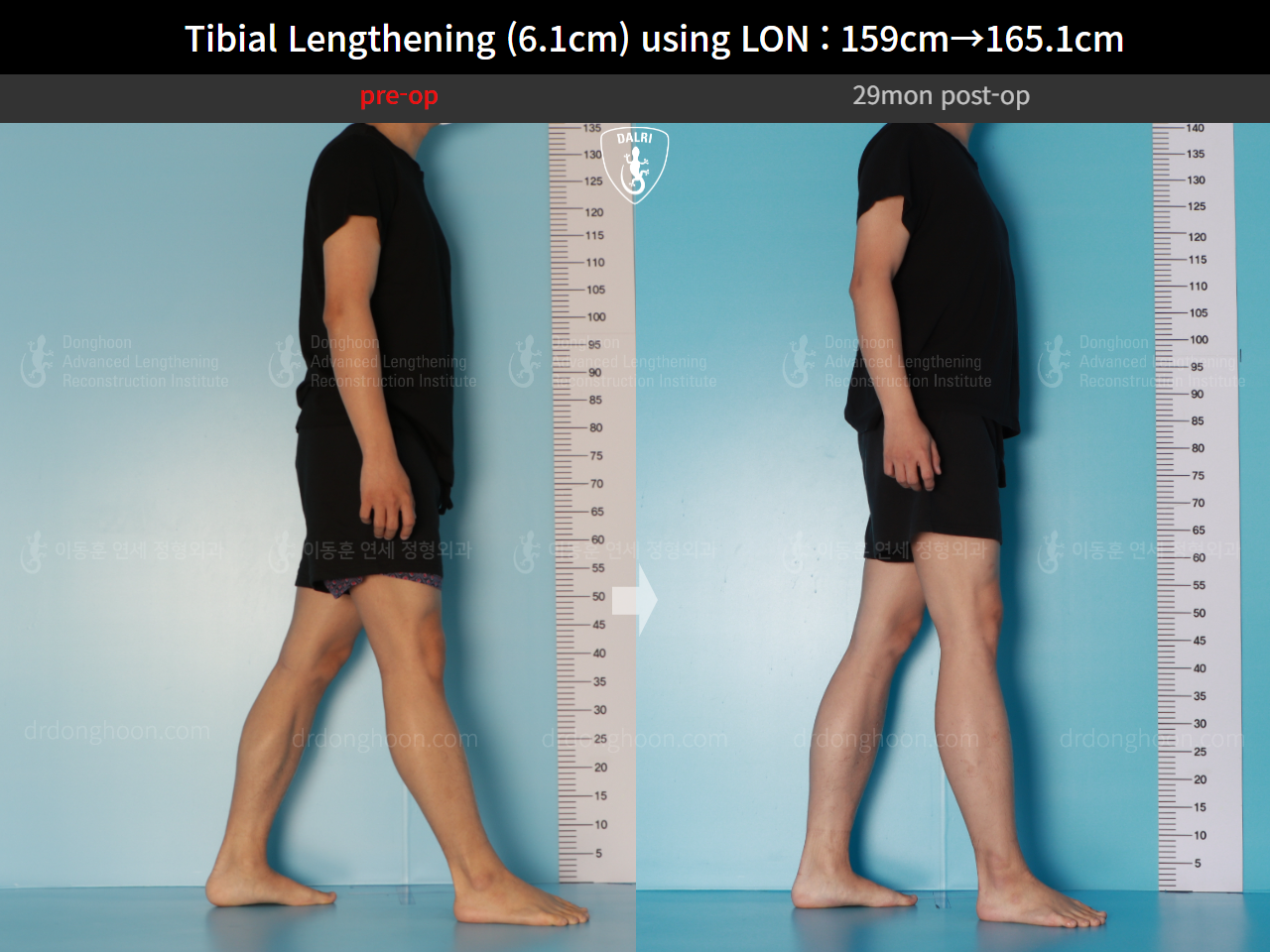 Before and after cll lon, case 16723424, image 5, Dr. Donghoon institute (DALRI)