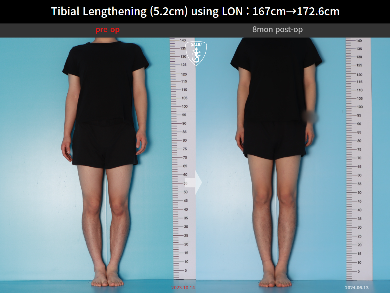 Before and after cll lon, case 29672720, image 1, Dr. Donghoon institute (DALRI)