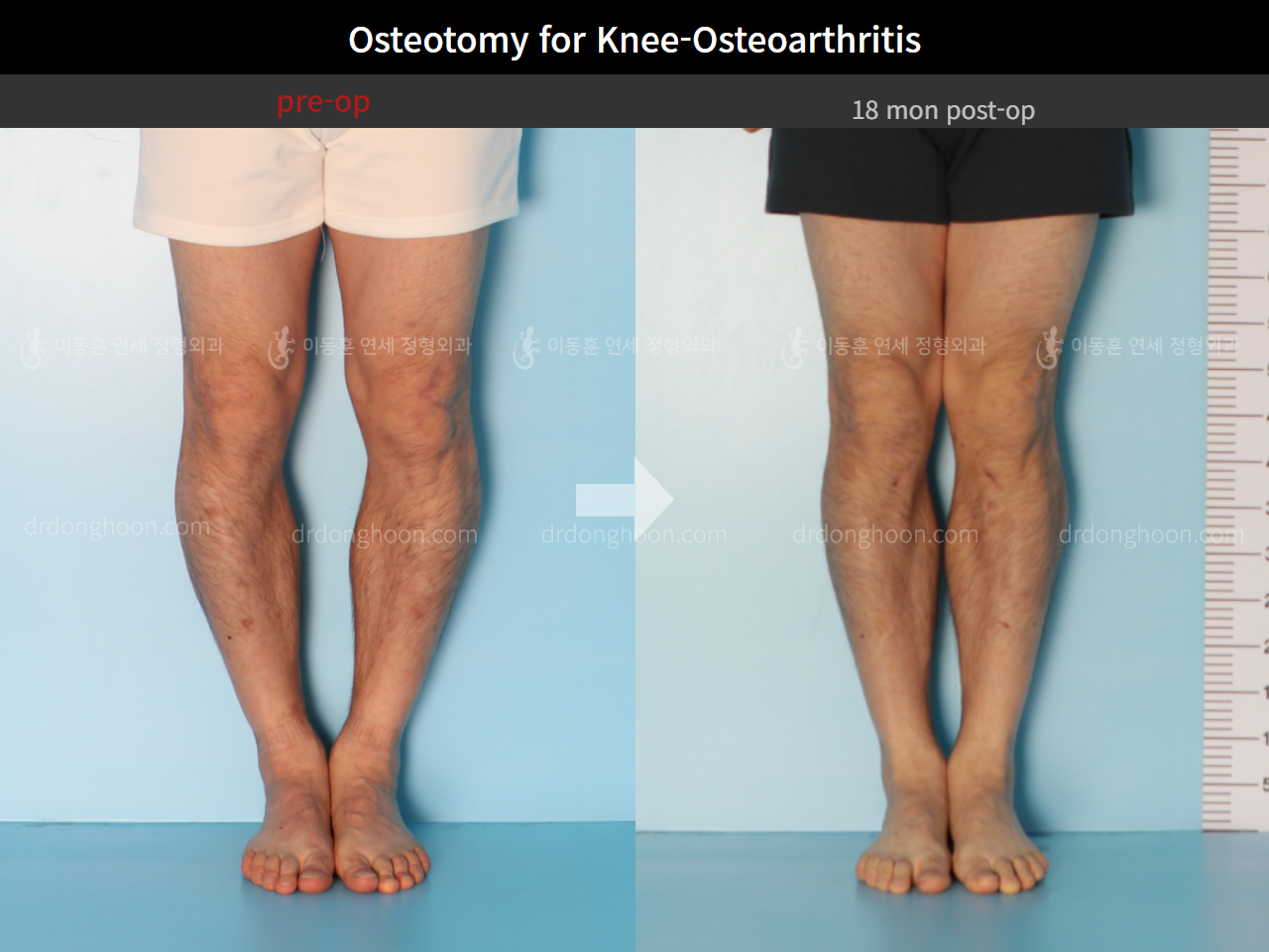 Before and after osteotomy for knee osteoarthritis, case 5394670, image 3, Dr. Donghoon institute (DALRI)