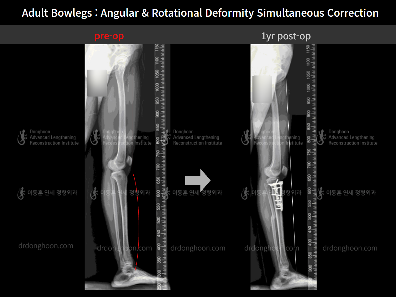 Before and after adult bowlegs, case 9058125, image 6, Dr. Donghoon institute (DALRI)