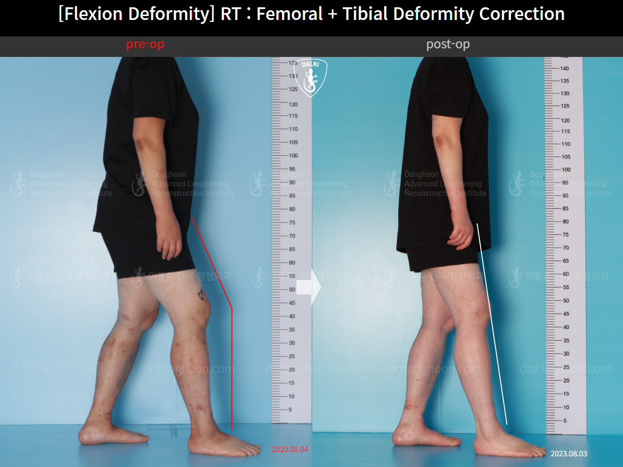 Before and after flexion deformity, case 15993081, image 2, Dr. Donghoon institute (DALRI)