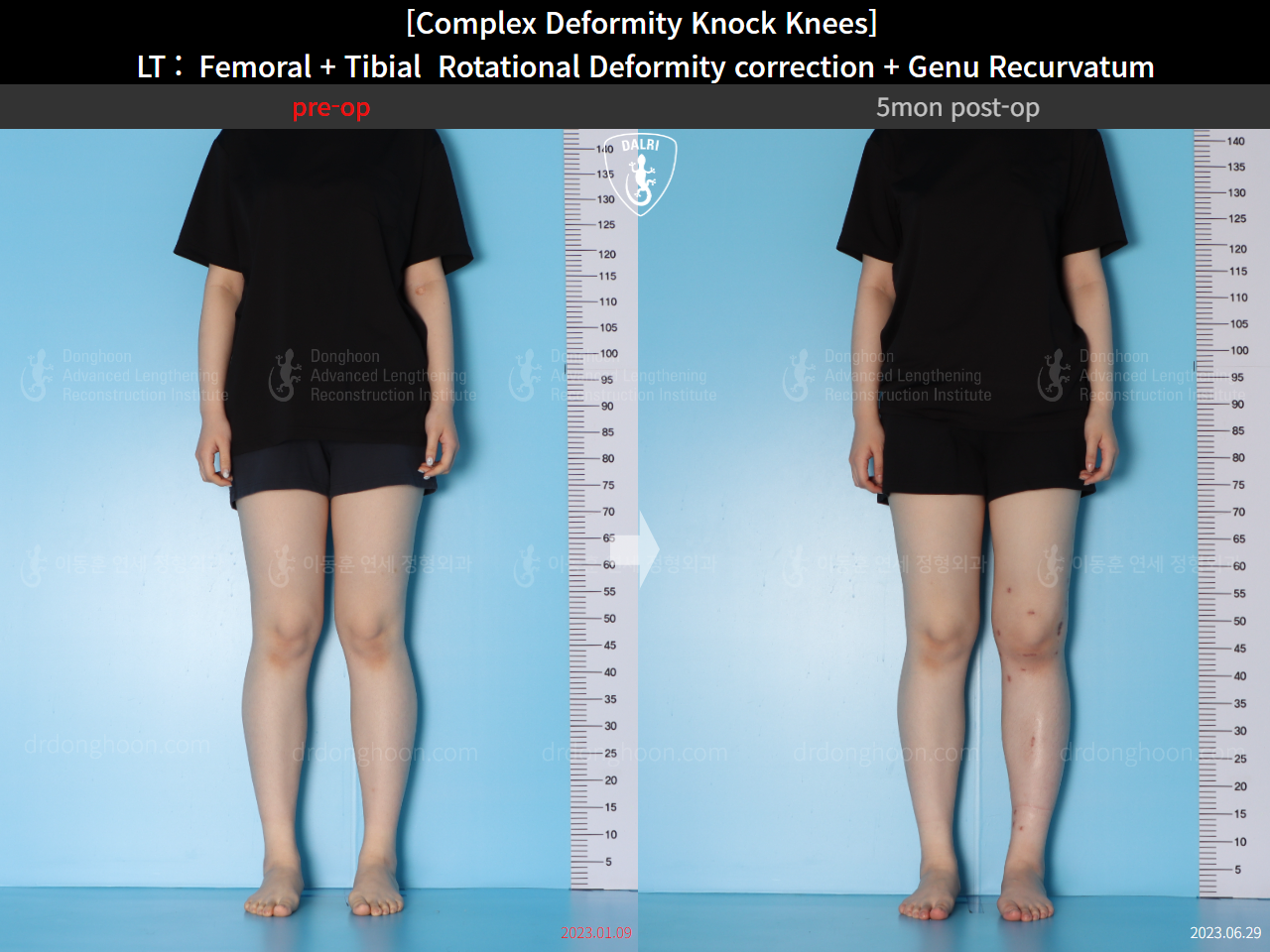 Before and after genu recurvatum, case 16212778, image 1, Dr. Donghoon institute (DALRI)