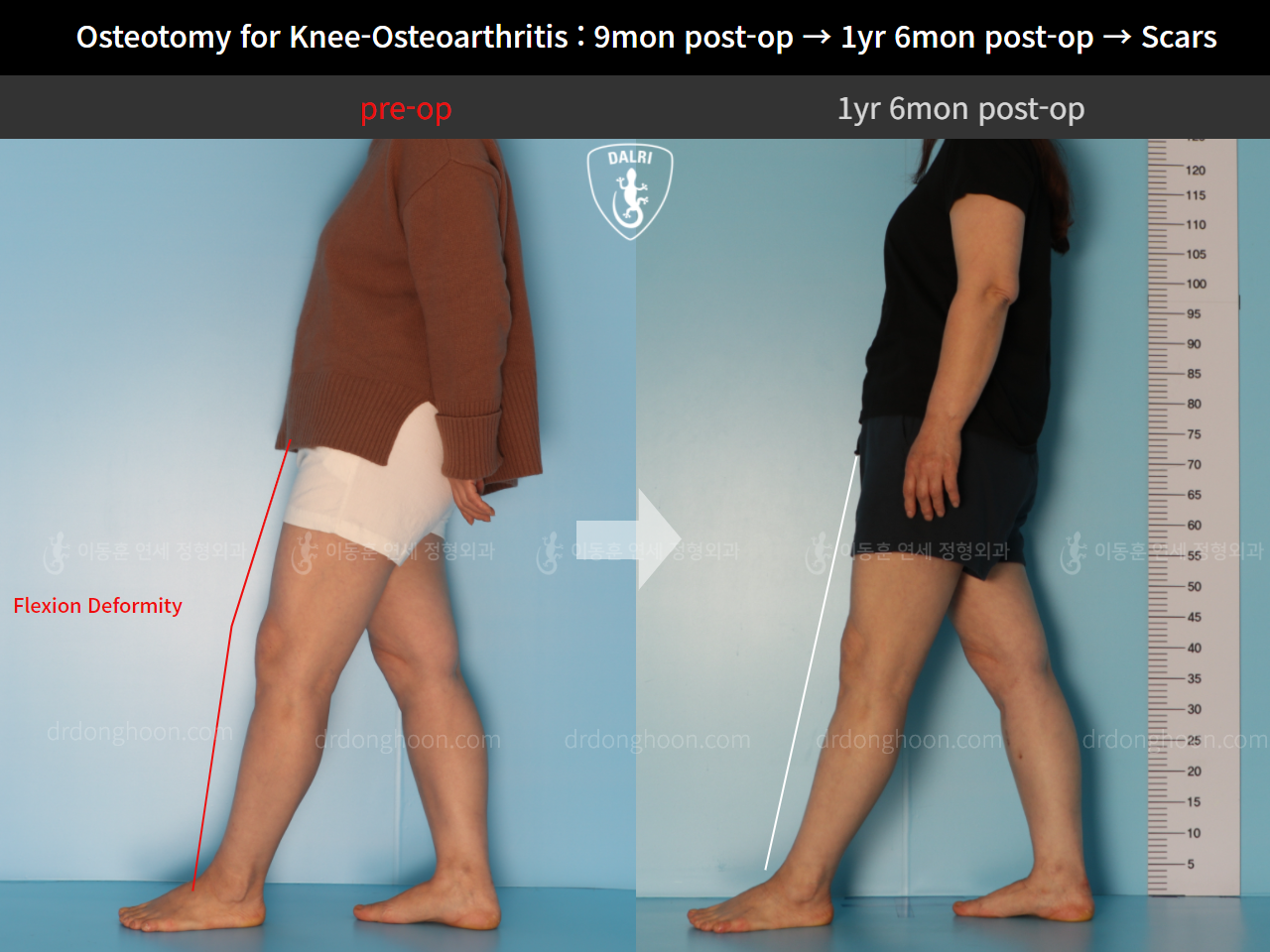Before and after osteotomy for knee osteoarthritis, case 11203744, image 5, Dr. Donghoon institute (DALRI)