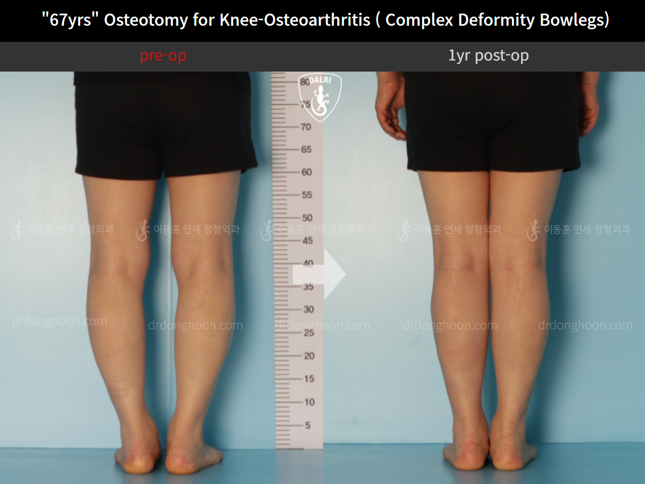 Before and after osteotomy for knee osteoarthritis, case 11339432, image 6, Dr. Donghoon institute (DALRI)