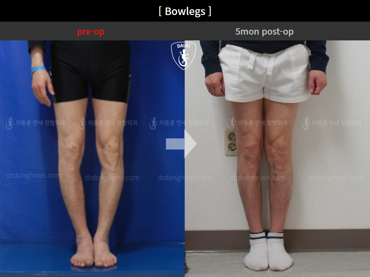 Before and after adult bowlegs, case 4586208, image 3, Dr. Donghoon institute (DALRI)