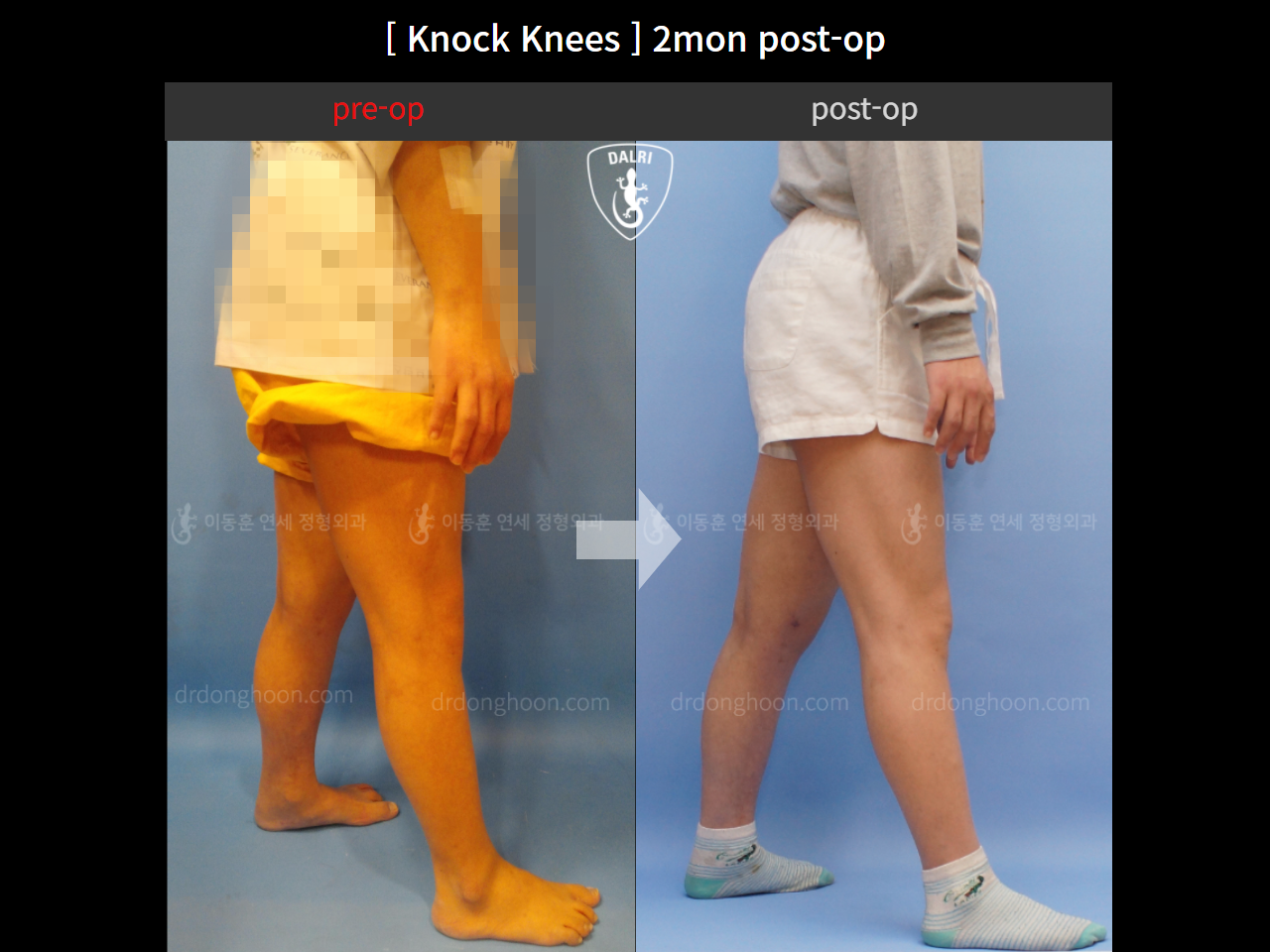 Before and after adult knock knees, case 4640593, image 3, Dr. Donghoon institute (DALRI)