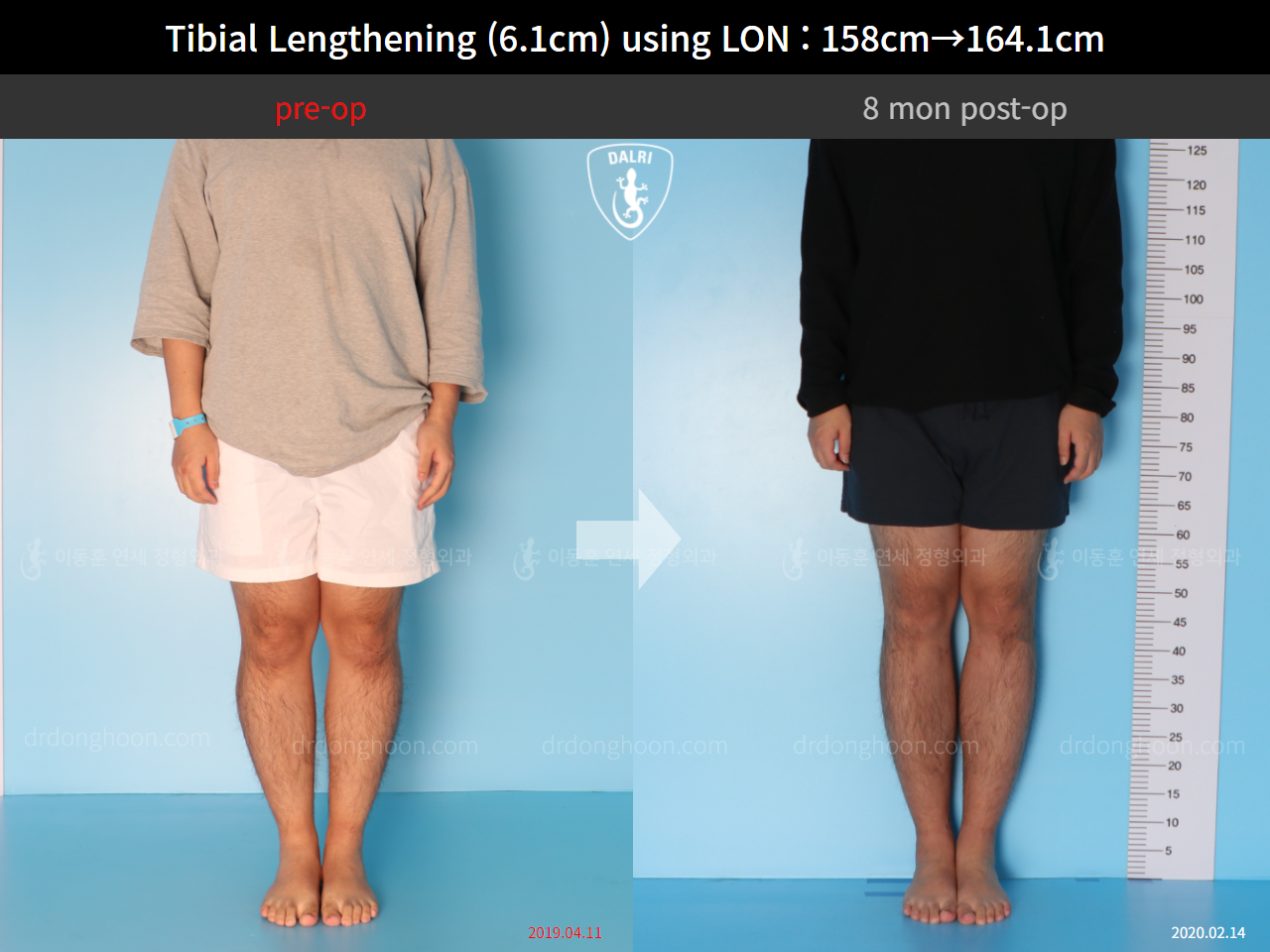 Before and after cll lon, case 4577743, image 1, Dr. Donghoon institute (DALRI)