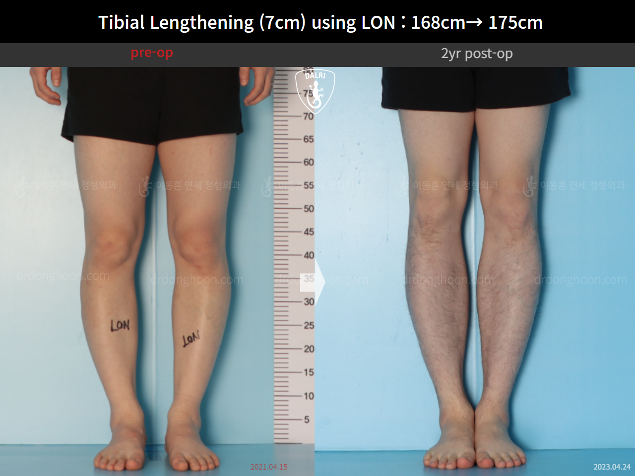 Before and after cll lon, case 14978046, image 7, Dr. Donghoon institute (DALRI)