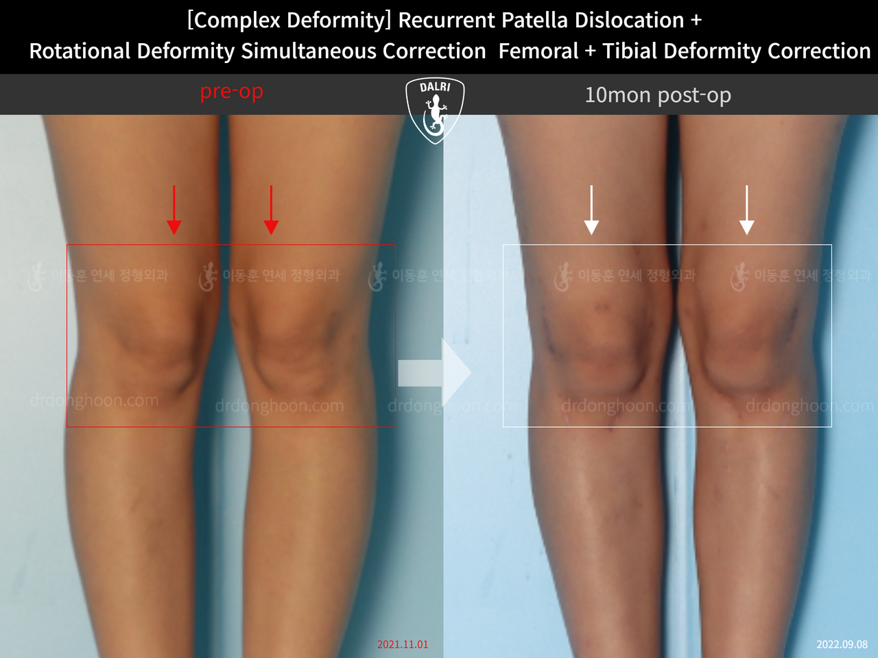 Before and after recurrent patella dislocation, case 12860886, image 4, Dr. Donghoon institute (DALRI)