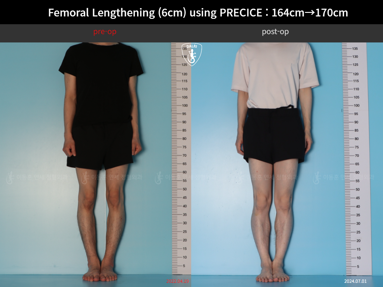 Before and after cll precice, case 33570290, image 1, Dr. Donghoon institute (DALRI)