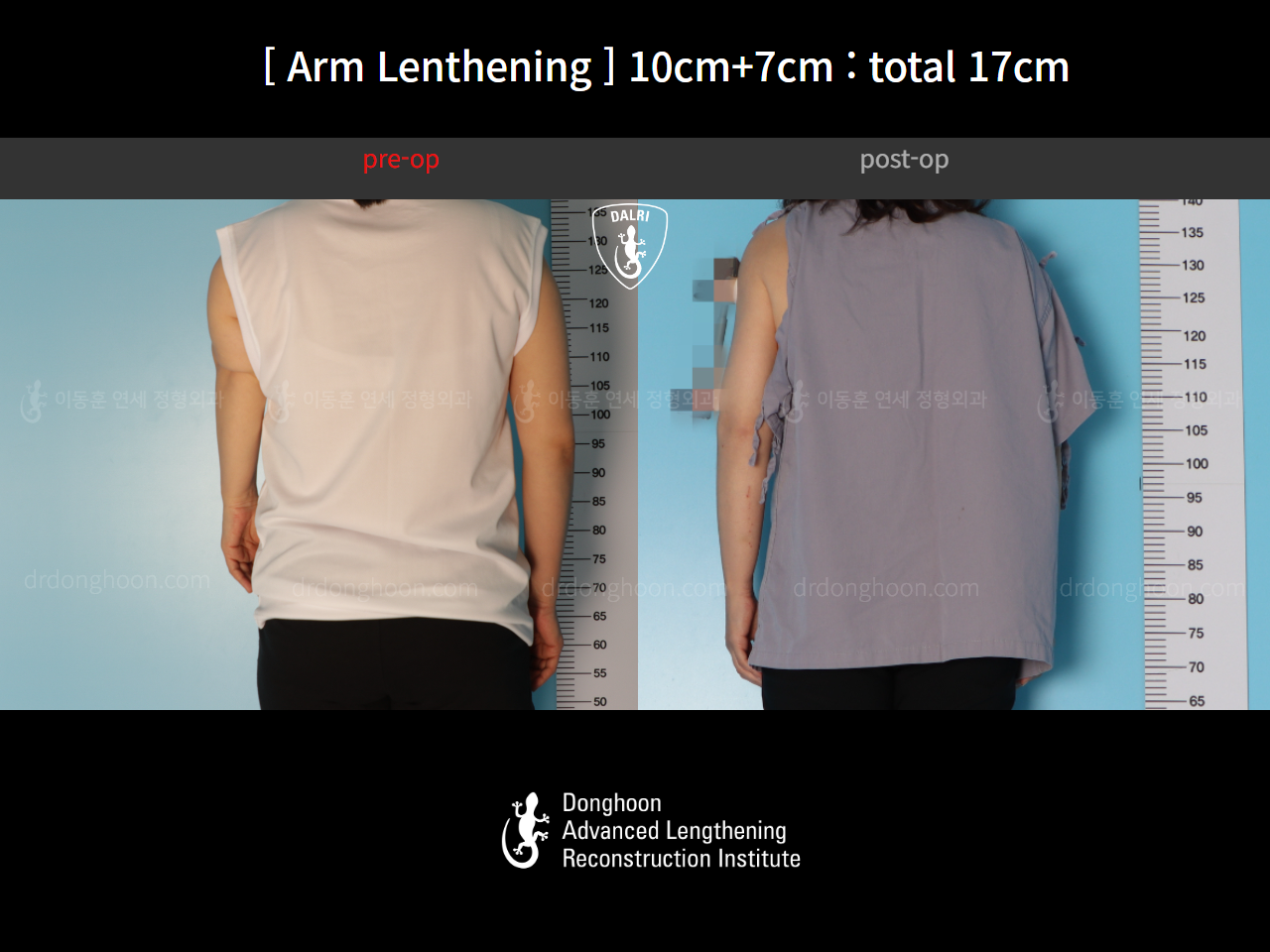 Before and after arm lengthening, case 17457909, image 4, Dr. Donghoon institute (DALRI)