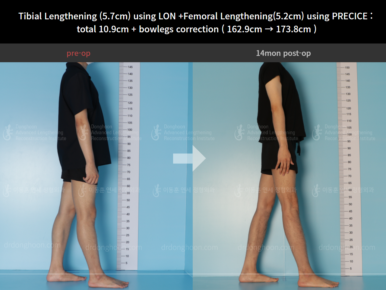 Before and after cll + deformity correction, case 8417894, image 7, Dr. Donghoon institute (DALRI)