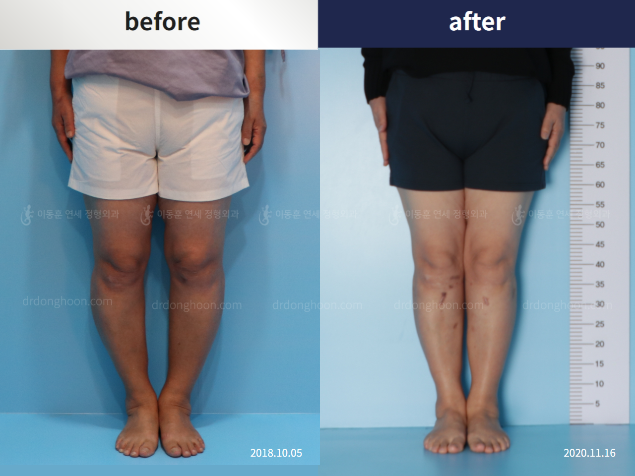 Before and after osteotomy for knee osteoarthritis, case 5346296, image 1, Dr. Donghoon institute (DALRI)