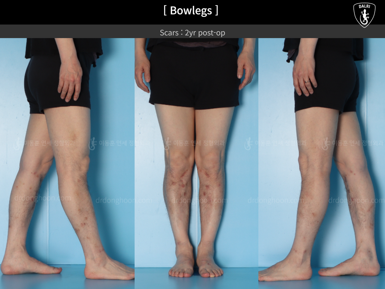 Before and after adult bowlegs, case 14445187, image 5, Dr. Donghoon institute (DALRI)
