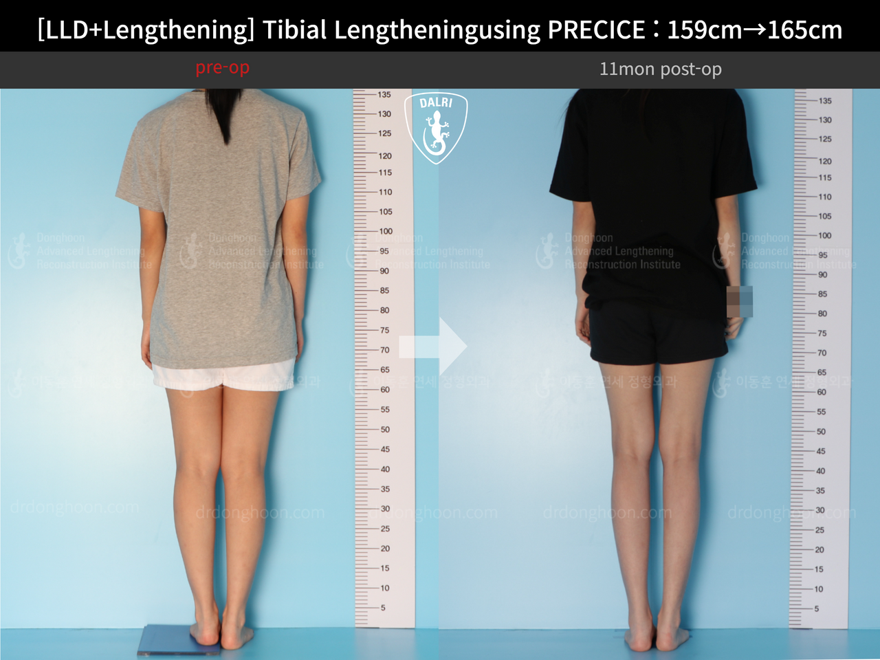 Before and after cll precice, case 13252418, image 2, Dr. Donghoon institute (DALRI)