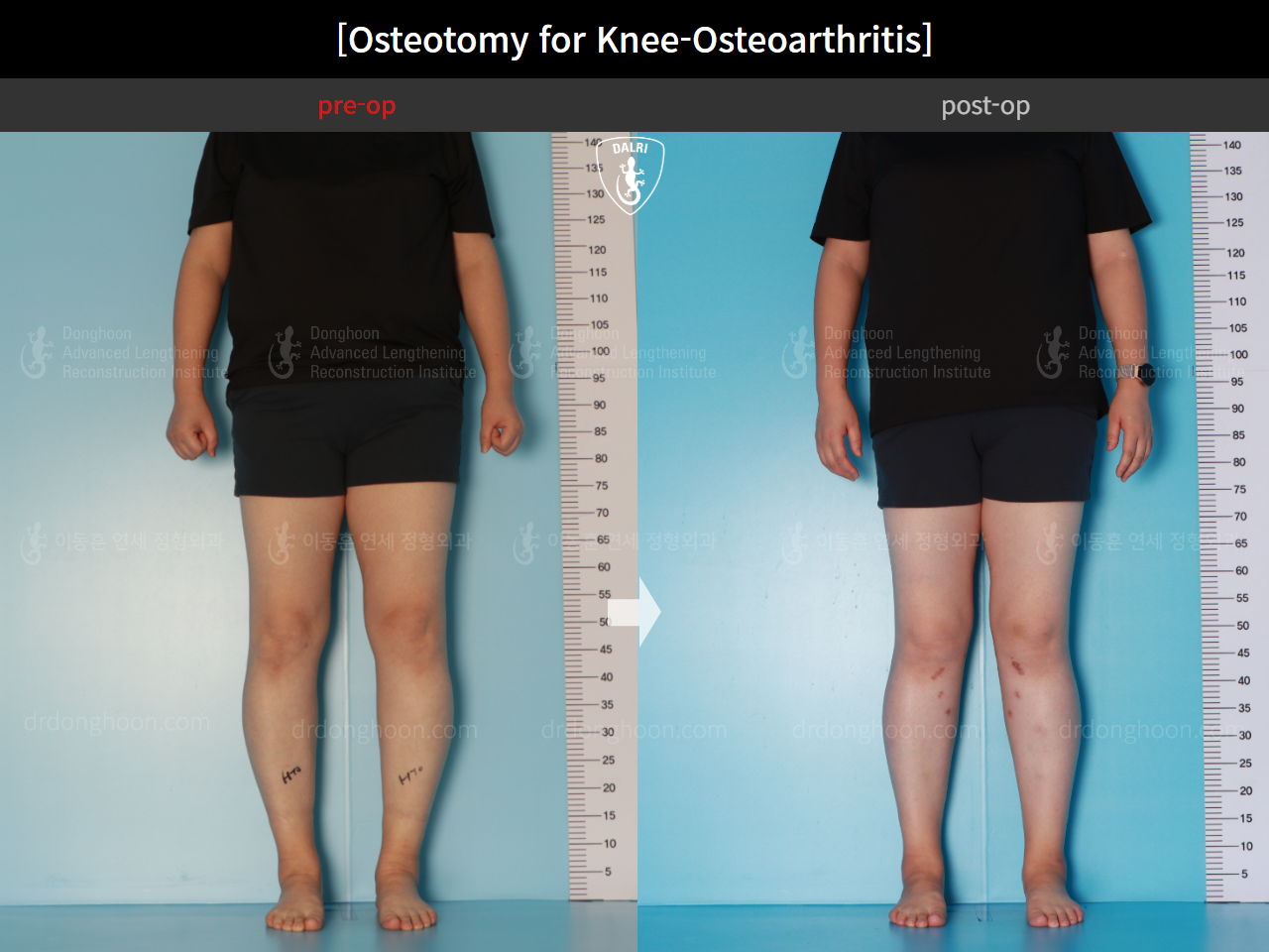 Before and after osteotomy for knee osteoarthritis, case 15944917, image 4, Dr. Donghoon institute (DALRI)