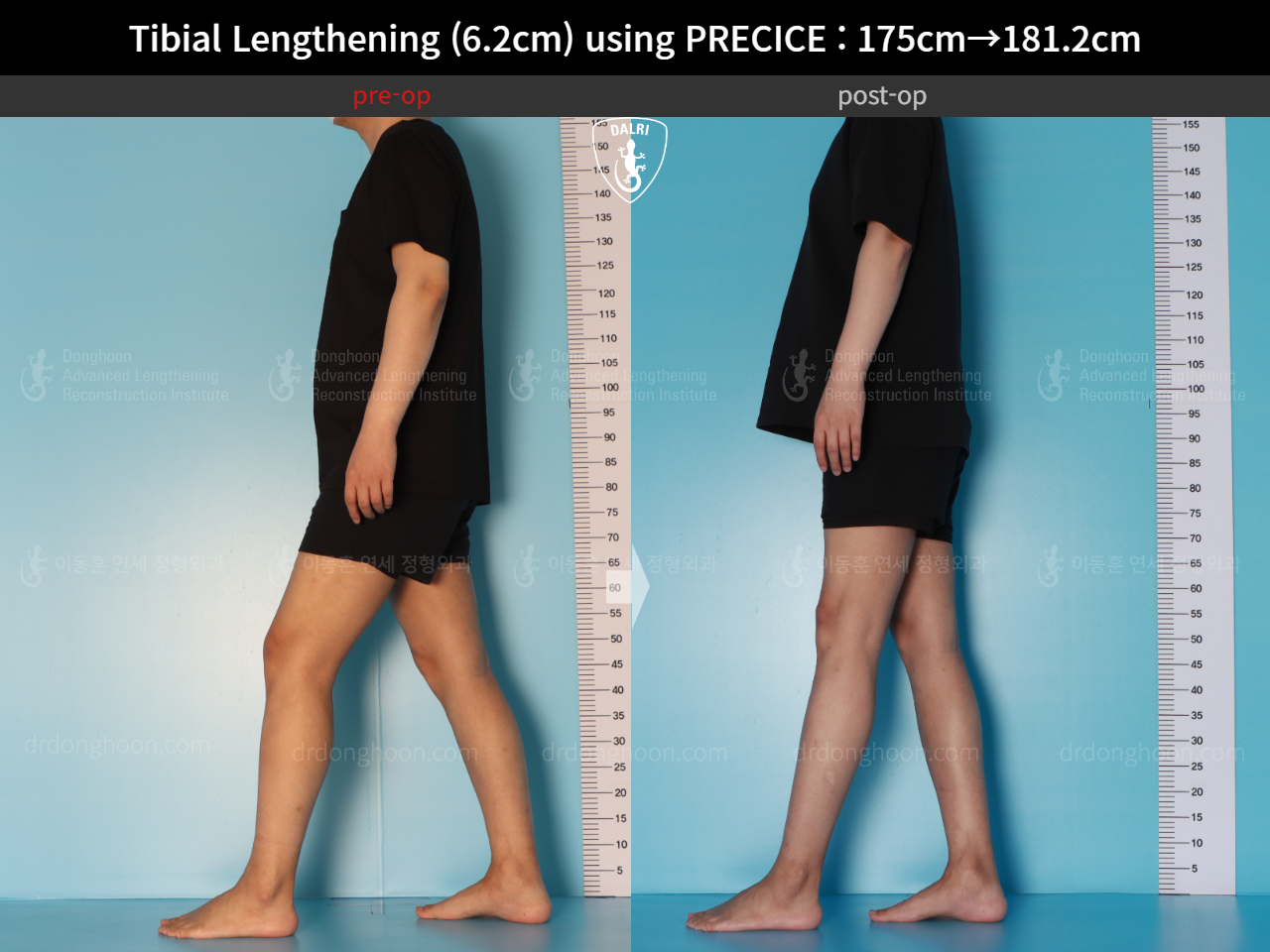 Before and after cll precice, case 16277428, image 5, Dr. Donghoon institute (DALRI)