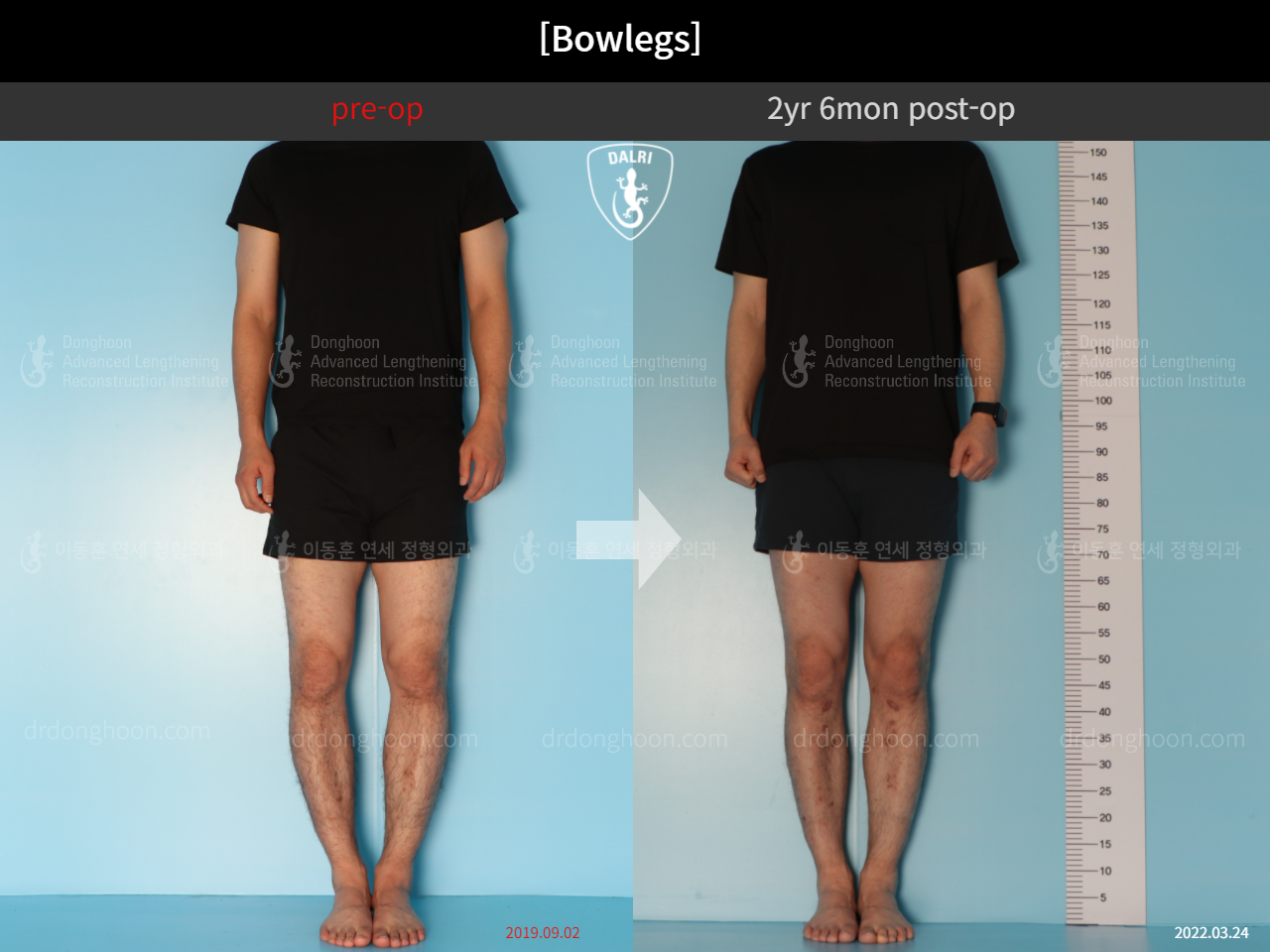 Before and after adult bowlegs, case 11037119, image 3, Dr. Donghoon institute (DALRI)