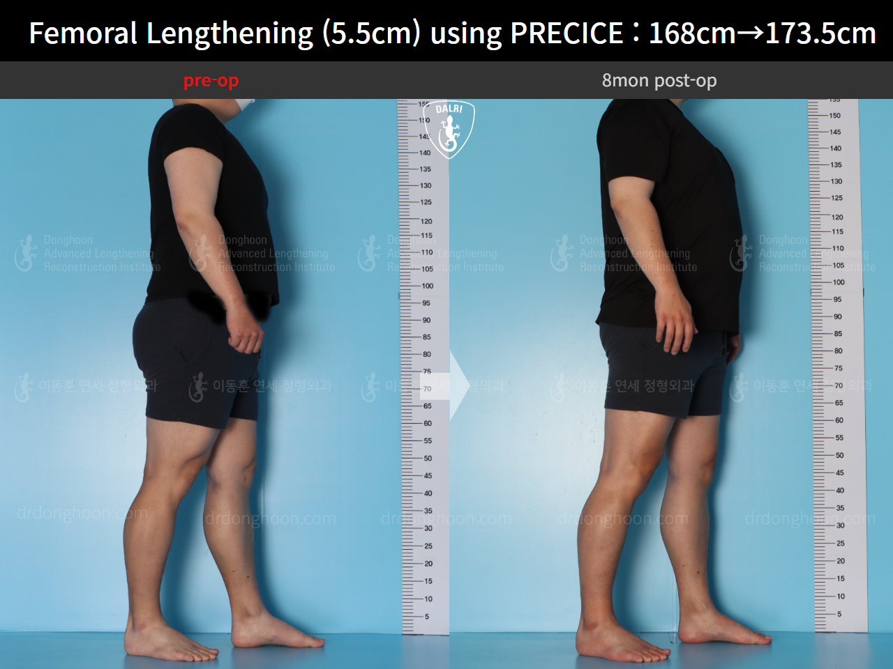 Before and after cll precice, case 16910900, image 5, Dr. Donghoon institute (DALRI)