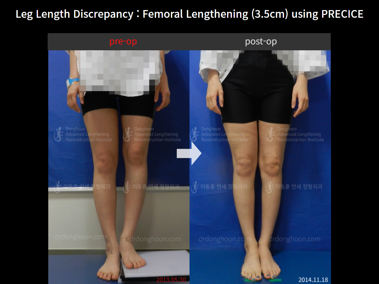 Before and after adult lld, case 4320329, image 1, Dr. Donghoon institute (DALRI)