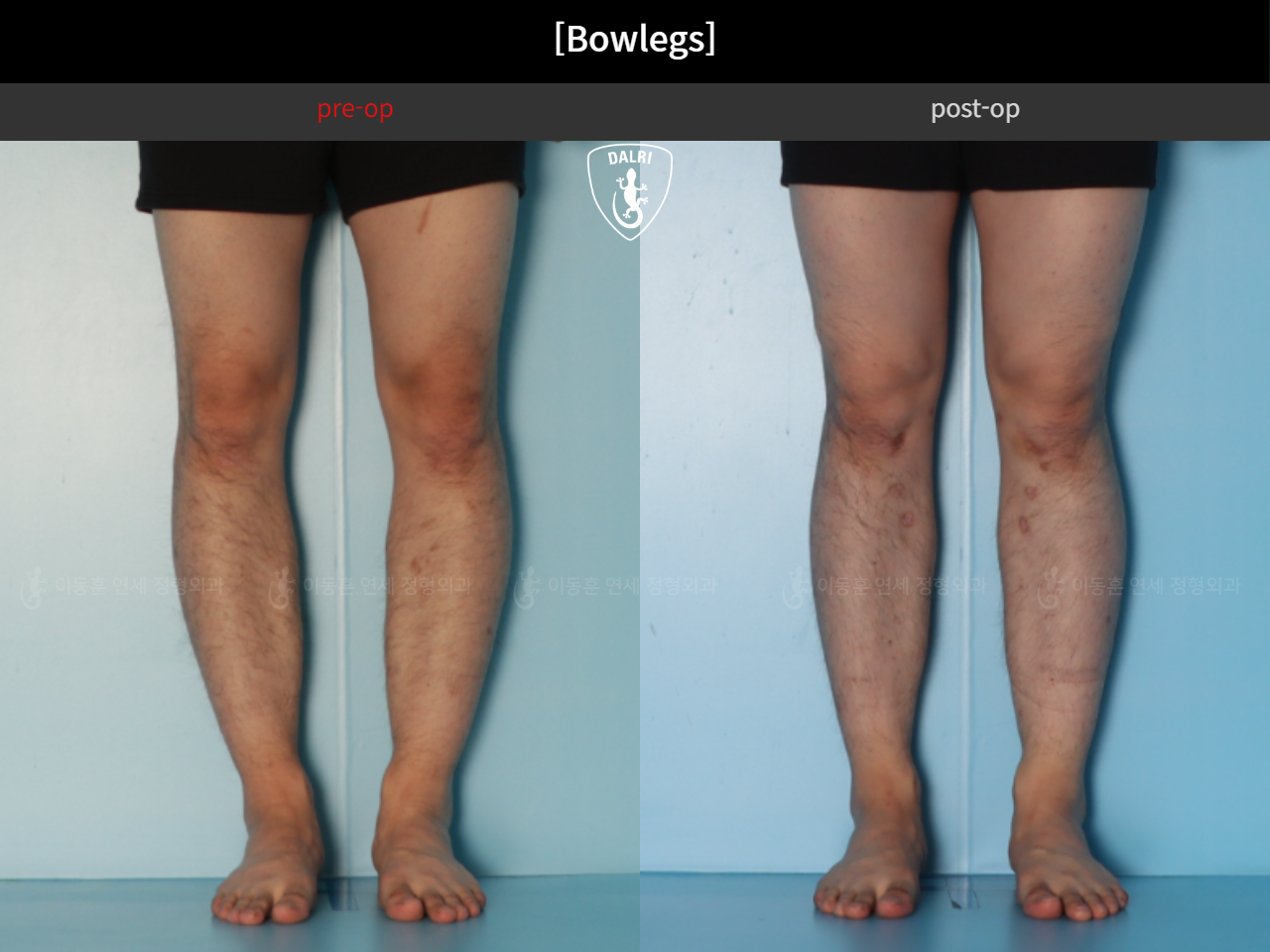 Before and after adult bowlegs, case 44111770, image 8, Dr. Donghoon institute (DALRI)