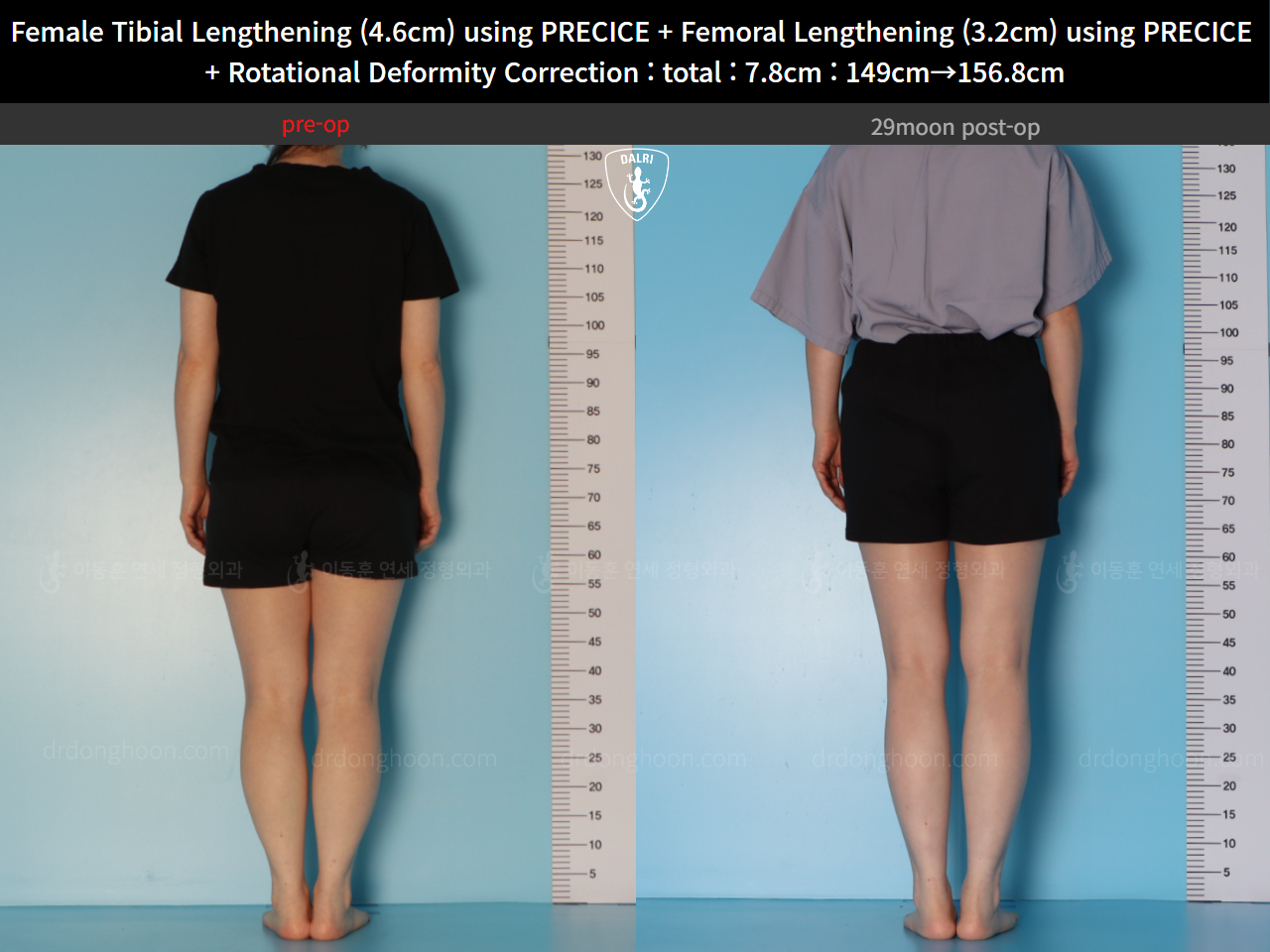 Before and after cll precice, case 123686647, image 3, Dr. Donghoon institute (DALRI)