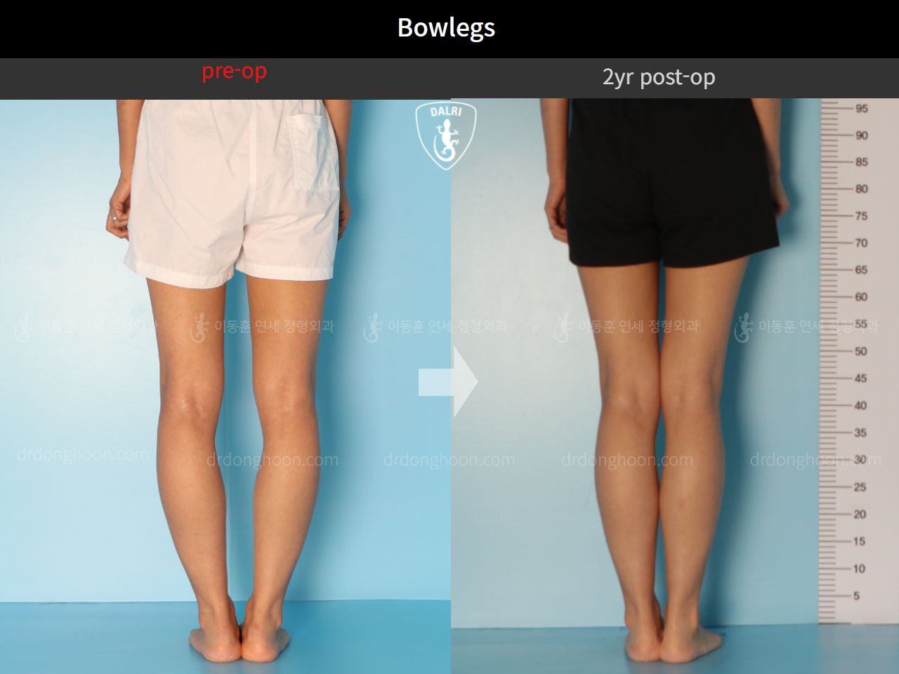 Before and after adult bowlegs, case 10023318, image 8, Dr. Donghoon institute (DALRI)