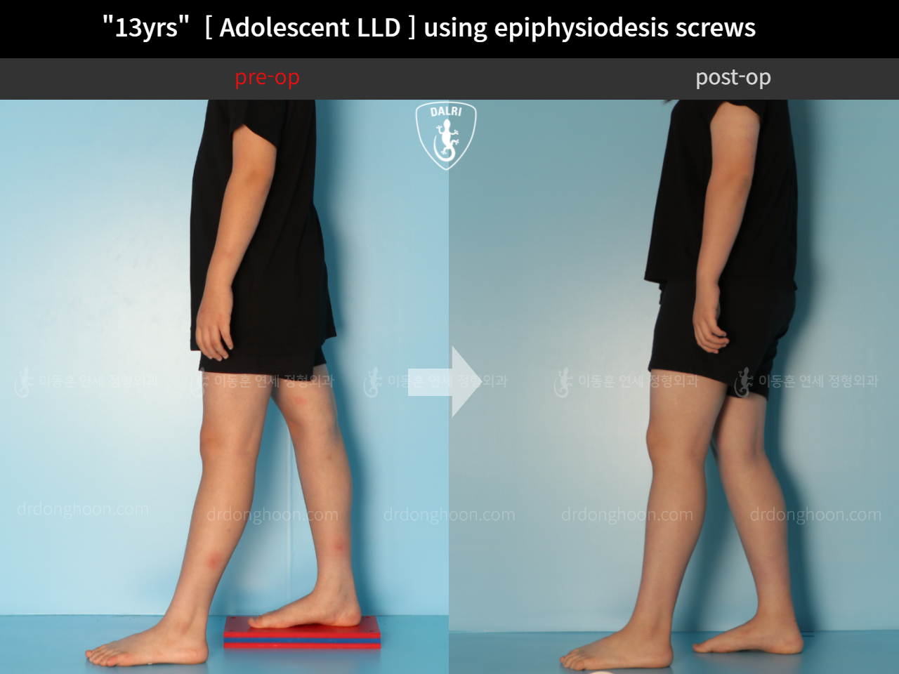 Before and after paediatric & adolescent lld, case 11773378, image 3, Dr. Donghoon institute (DALRI)