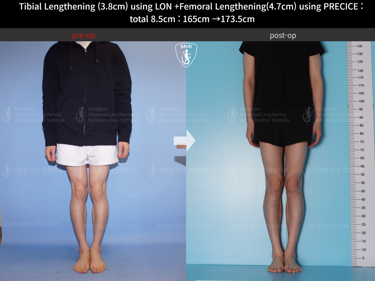Before and after cll precice, case 4576980, image 5, Dr. Donghoon institute (DALRI)