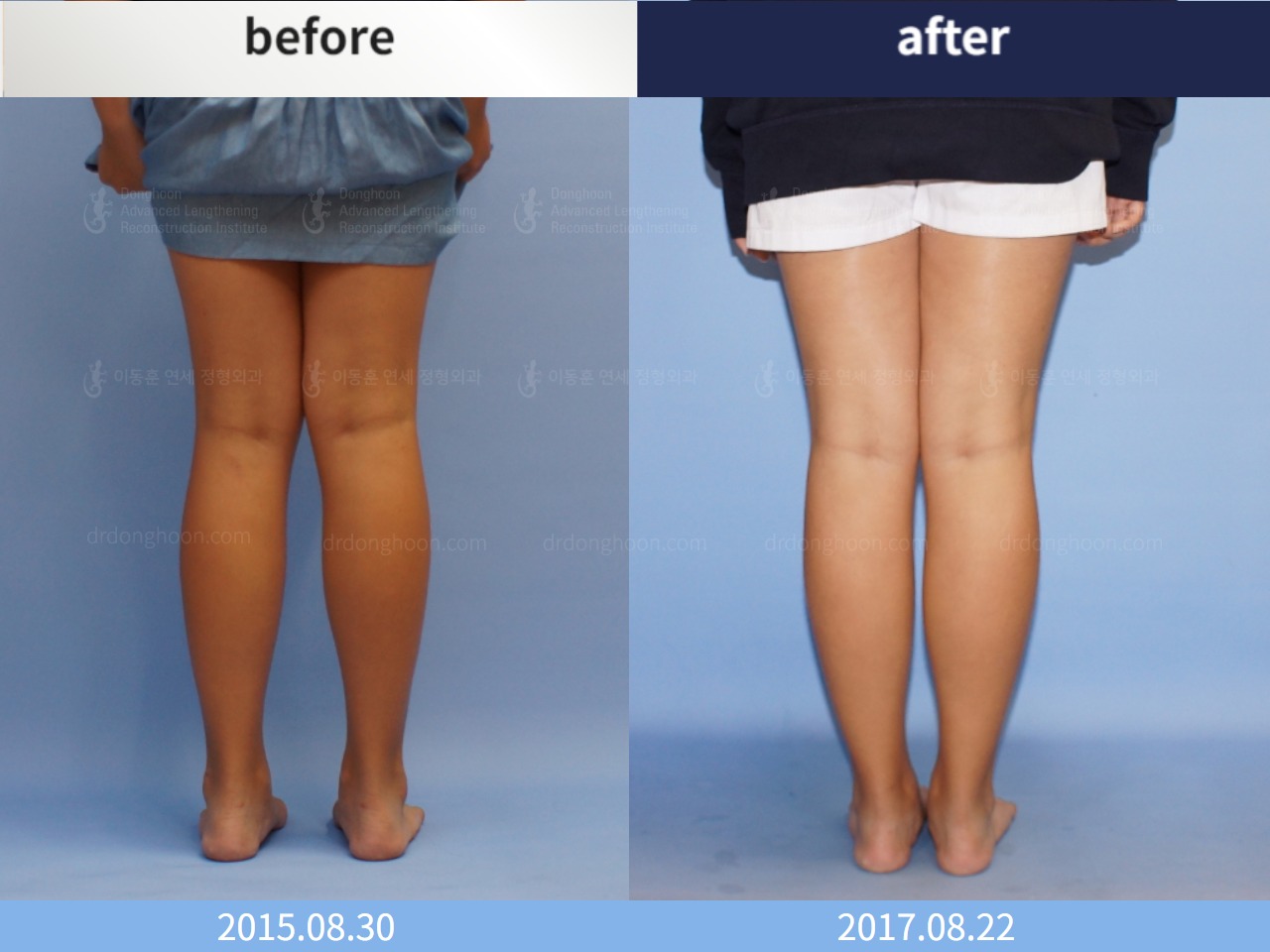 Before and after paediatric & adolescent knock knees, case 4310921, image 2, Dr. Donghoon institute (DALRI)