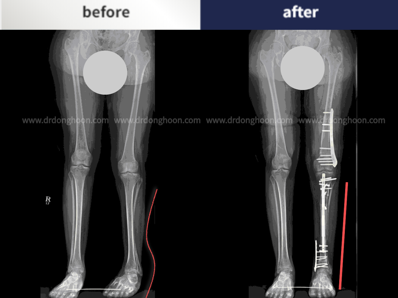 Before and after congenital condition, case 4795353, image 3, Dr. Donghoon institute (DALRI)