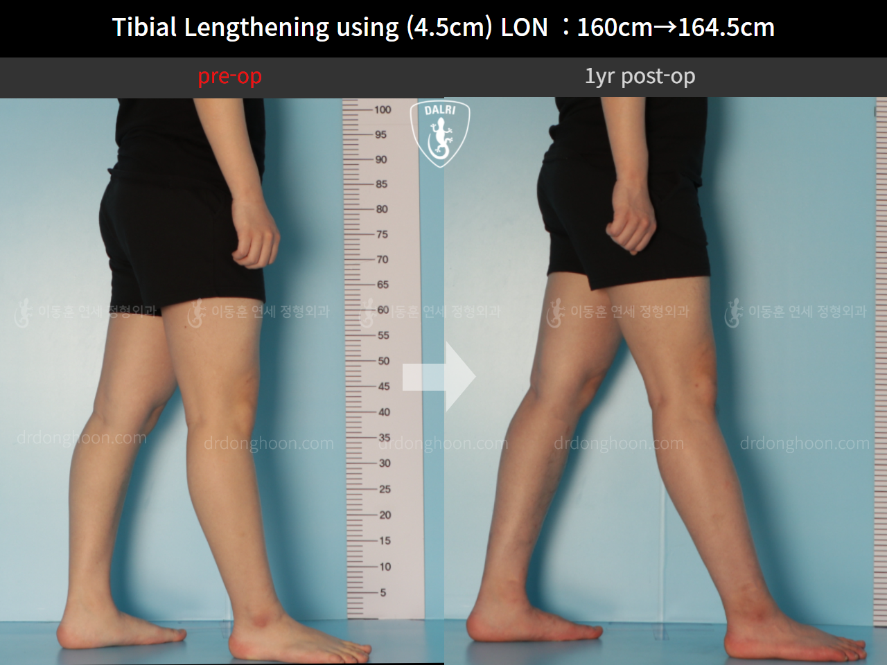Before and after cll lon, case 10600029, image 8, Dr. Donghoon institute (DALRI)