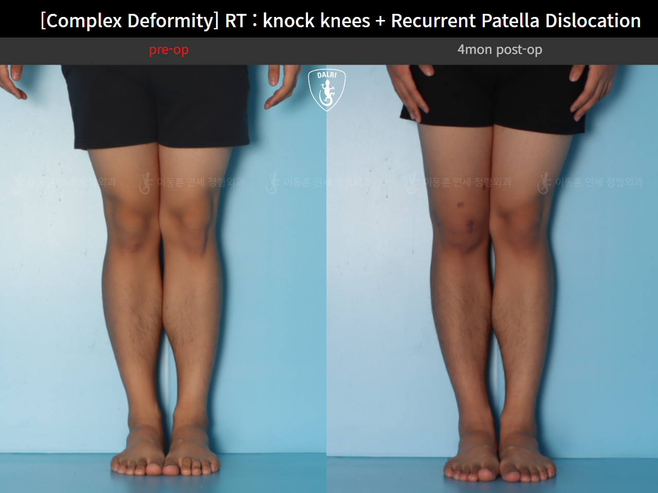 Before and after complex deformity, case 125841720, image 8, Dr. Donghoon institute (DALRI)