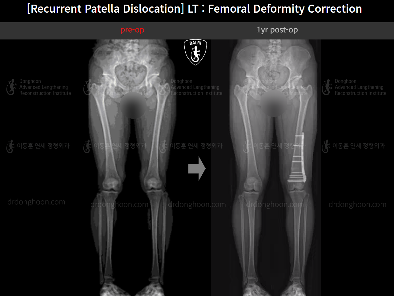 Before and after recurrent patella dislocation, case 15125370, image 7, Dr. Donghoon institute (DALRI)