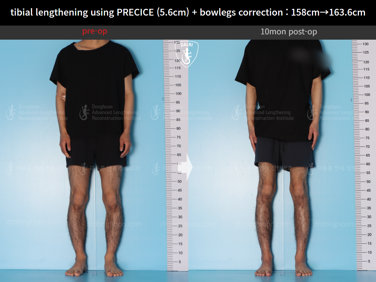 Before and after cll precice, case 15043786, image 2, Dr. Donghoon institute (DALRI)