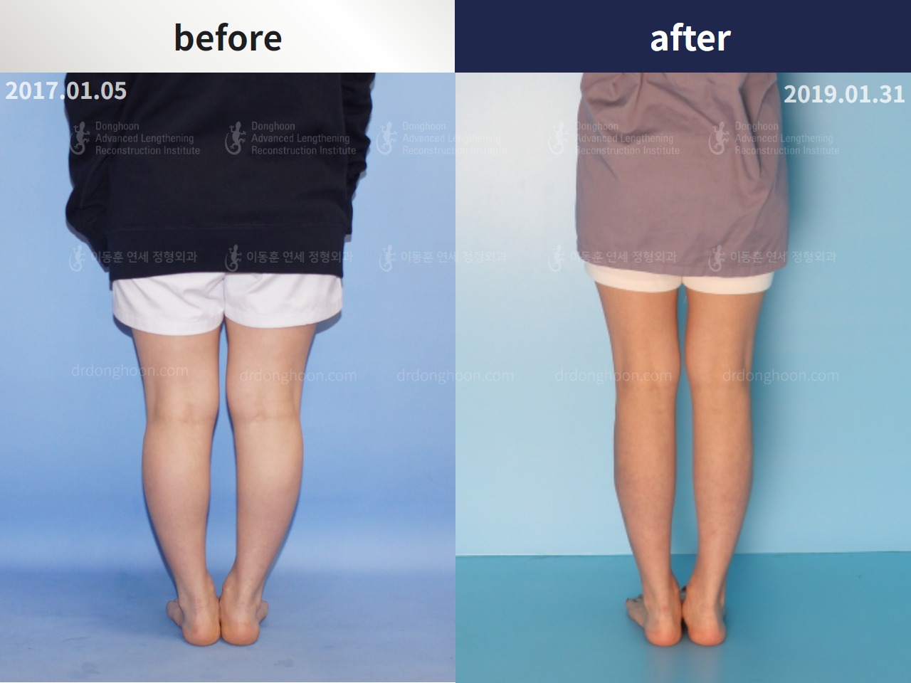 Before and after adult bowlegs, case 4310962, image 2, Dr. Donghoon institute (DALRI)