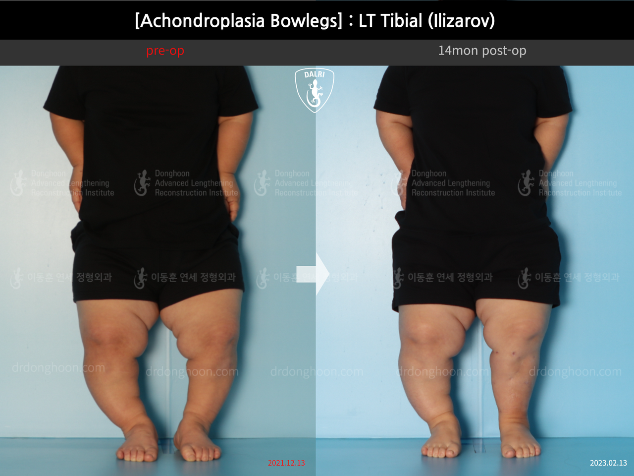 Before and after congenital condition, case 14296141, image 4, Dr. Donghoon institute (DALRI)
