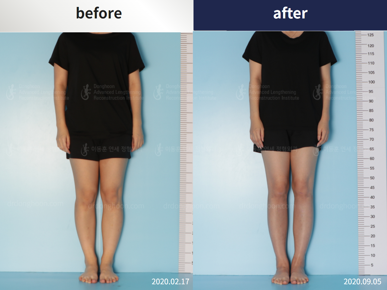 Before and after cll lon, case 4860839, image 2, Dr. Donghoon institute (DALRI)