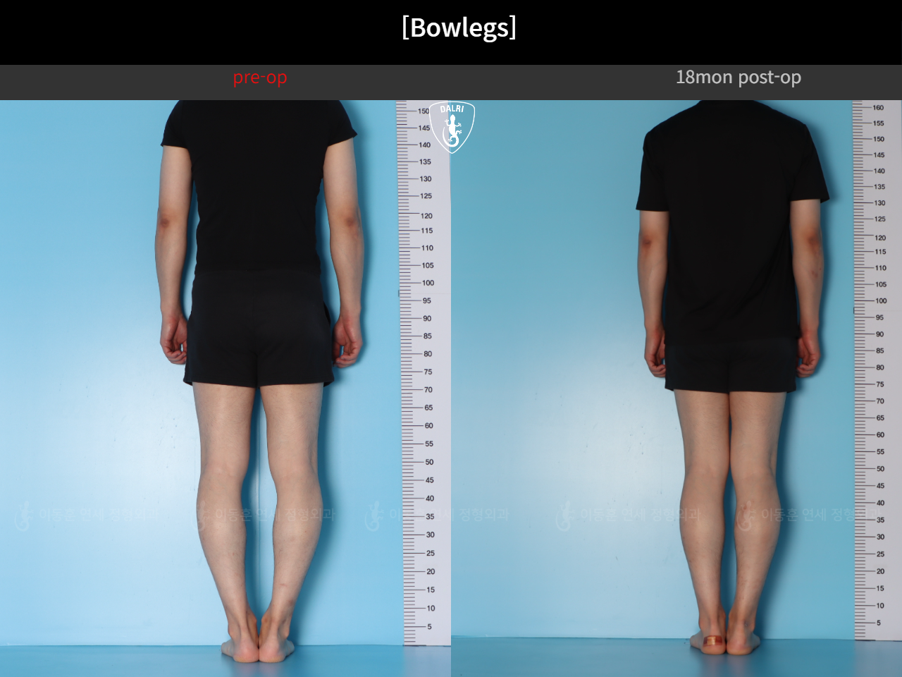 Before and after adult bowlegs, case 124254182, image 4, Dr. Donghoon institute (DALRI)